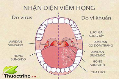 Biểu hiện của bệnh viêm họng hạt